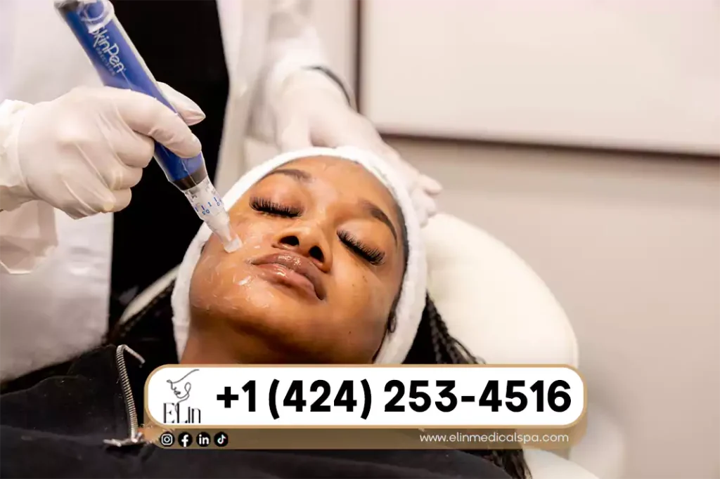 At-Home vs Professional Microneedling