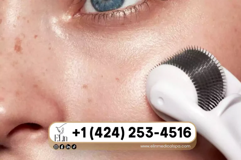Is Microneedling Safe in 2026?