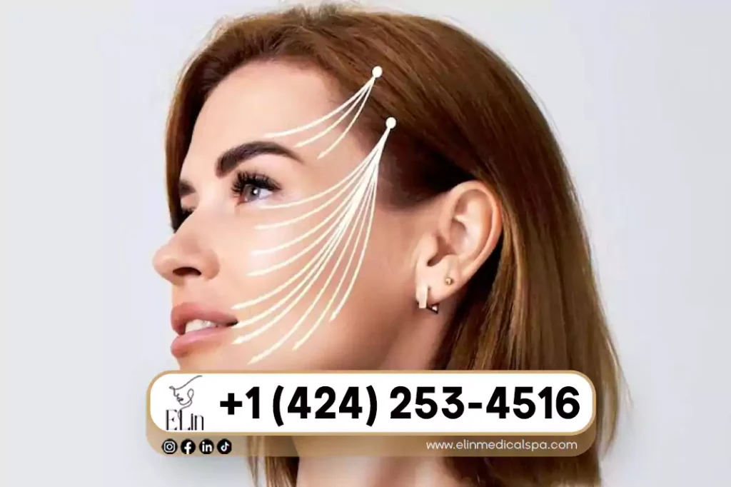 Is PDO Thread Lift Worth the Cost in Beverly Hills