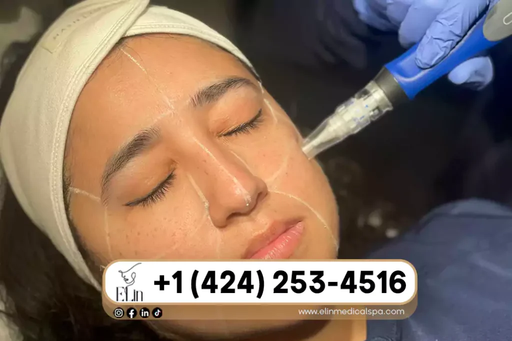 Microneedling Downtime