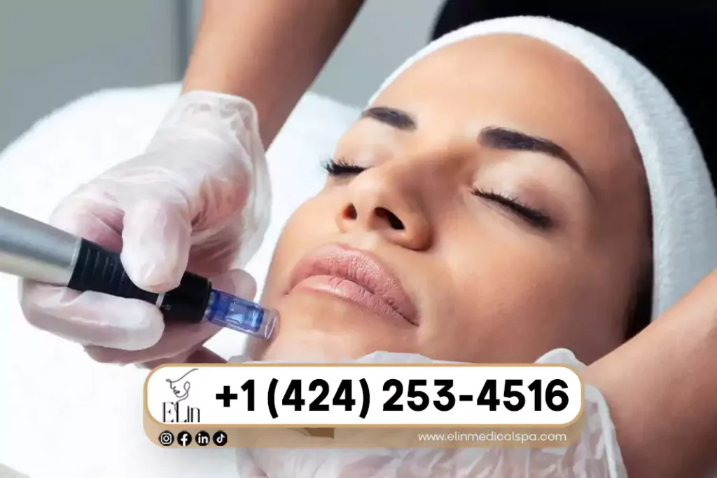 Microneedling Guide 2026