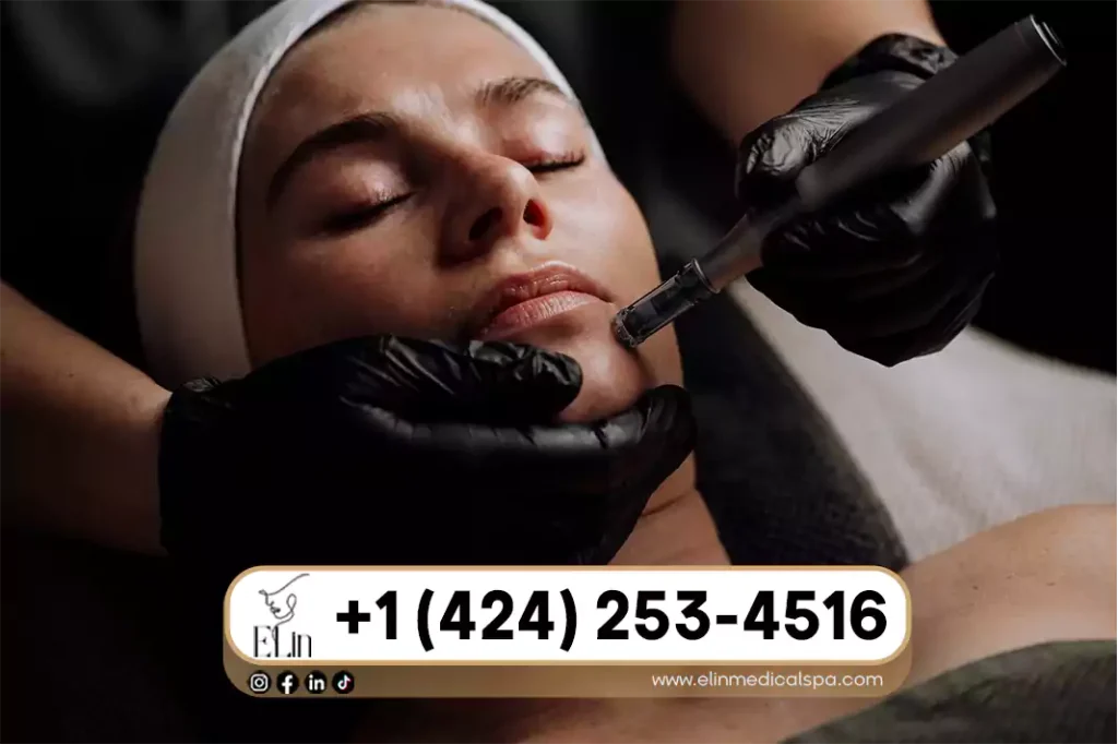 Microneedling for Acne Scars