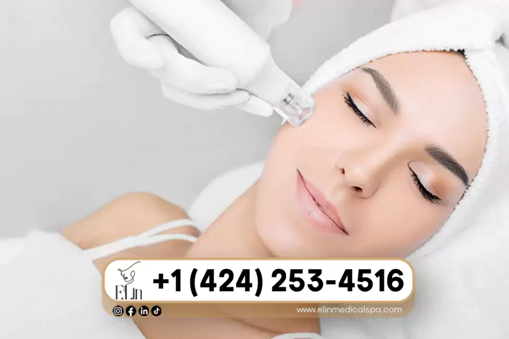 Microneedling for Hyperpigmentation