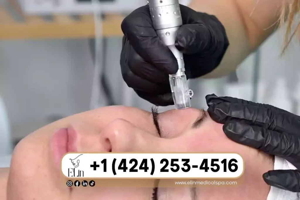 Microneedling for Large Pores