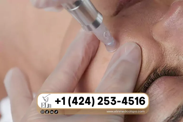 Microneedling for Large Pores: Before & After Results