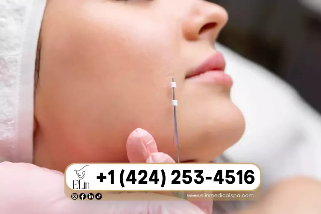  PDO Thread Lift Cost in Beverly Hills.