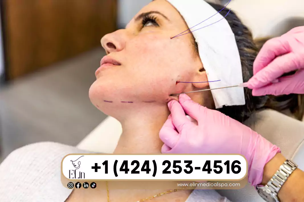 PDO Threads Lift: Non-Surgical Facelift Guide