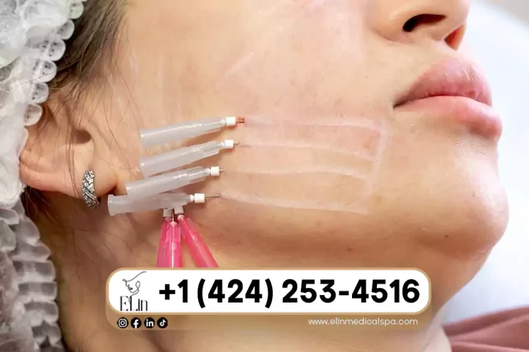 PDO Threads for Cheek Lift: Before & After