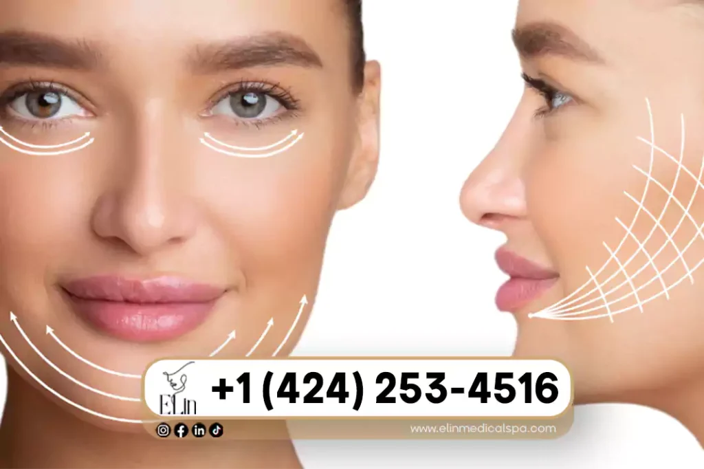 PDO Threads for Jawline Contouring