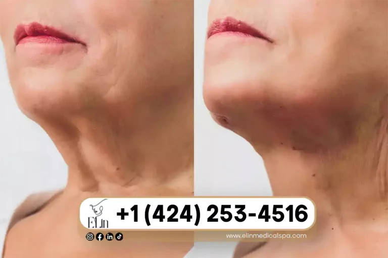 PDO Threads for Neck Lift