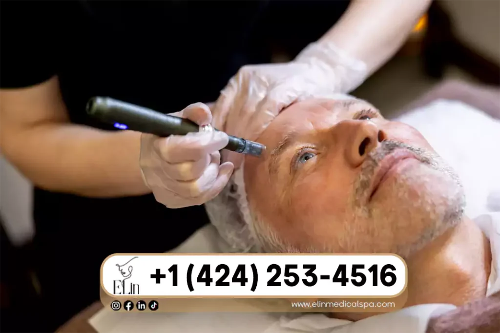 RF Microneedling vs Traditional