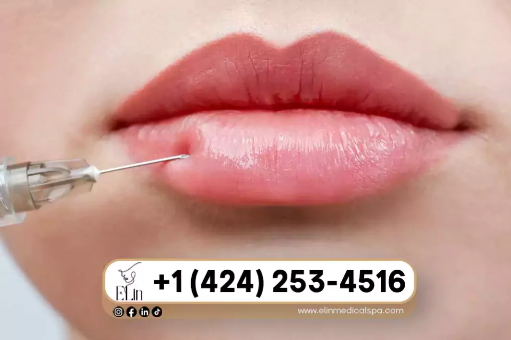 Lip Filler Cost in Beverly Hills