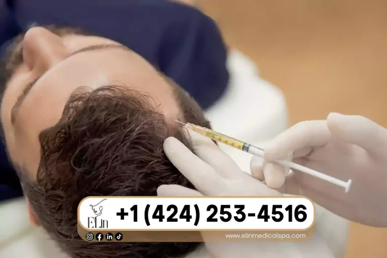 Hair Restoration in Beverly Hills: PRF Treatment Explained